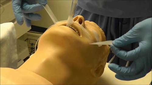 固定气管内导管