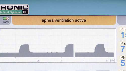 菲萍新生儿呼吸机——PSV模式