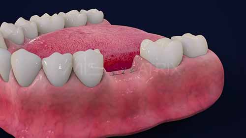 种植牙3D动画教程