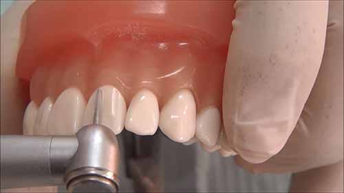 全瓷冠牙体预备