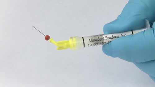 根管治疗的冲洗方案