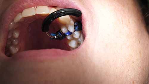 填充牙齿间的窝洞