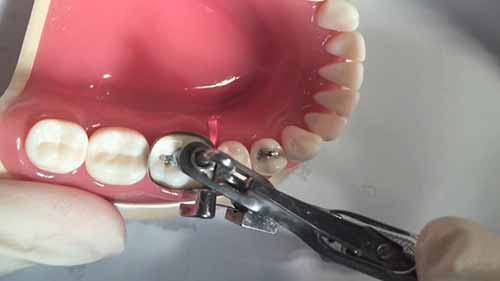 II类洞的制备与修复