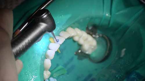 III类的制备与修复