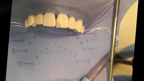 IV类洞的制备与修复