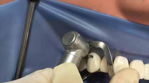 V类洞的制备与修复