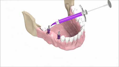 开放托盘印模技术