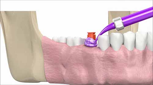 闭合托盘印模技术