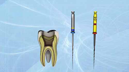 牙科根管锉介绍