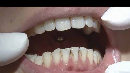 牙齿清洁抛光膏