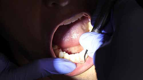 去除牙渍和牙垢