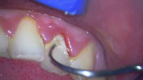 牙龈出血的原因