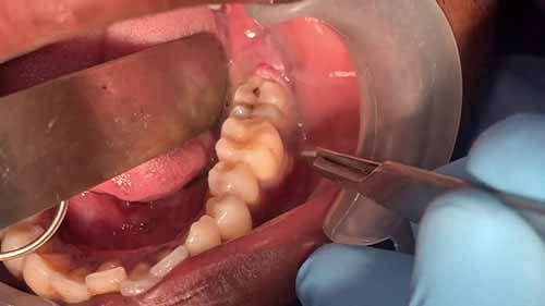 拔智齿手术视频