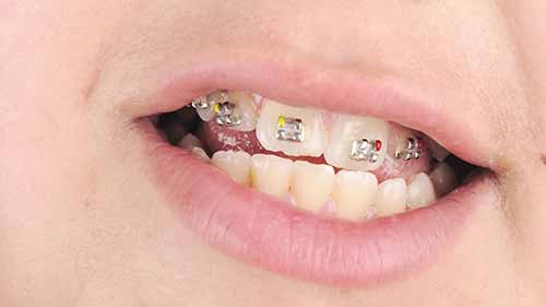 哪种牙套适合你