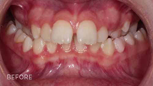 使用牙套前后对比