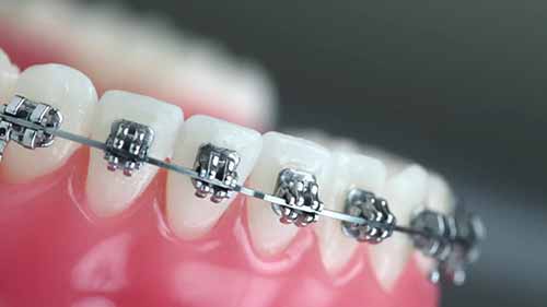 正畸紧急情况处理