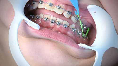 如何佩戴矫正橡皮圈