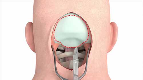 颅骨切除术3D动画