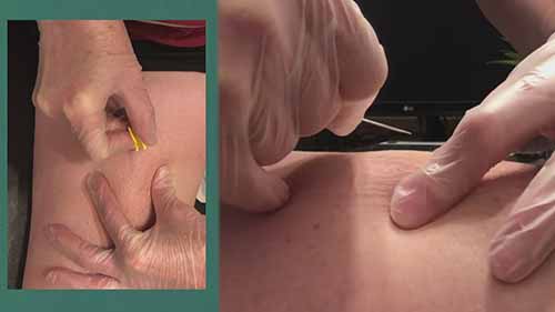 皮下注射与护理