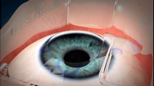 准分子激光手术（LASIK）