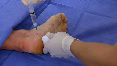 足底筋膜炎手术