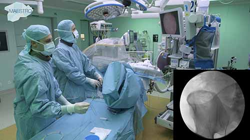 输尿管镜激光碎石术