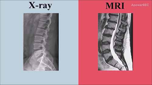 X射线和核磁共振的成像对比