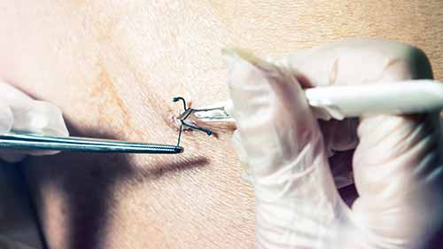 如何缝合和打结