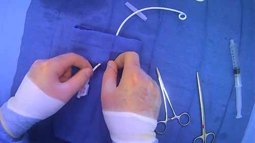 导管缝合固定——单结