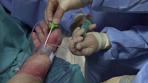 冠状动脉造影和血管成形术