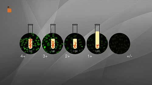 IFA检测4如何筛查抗核抗体IFA阳性