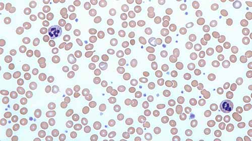 贫血患者的血涂片检查