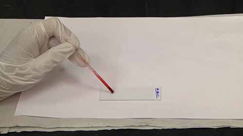 疟疾薄涂片制备