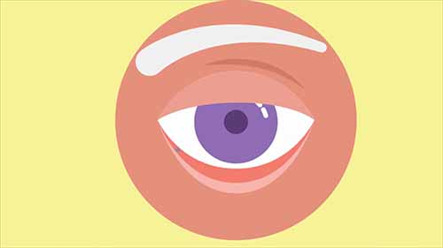 什么是眼睑外翻