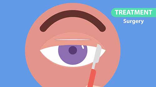 什么是眼睑下垂