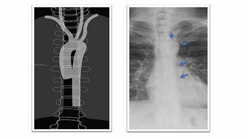 了解胸部X光——形状的重要性