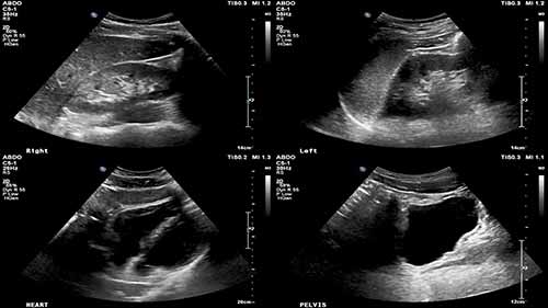 超声教程——FAST扫描