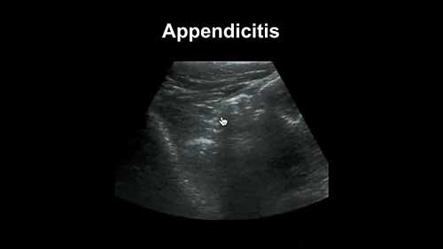 如何利用超声成像鉴别阑尾炎