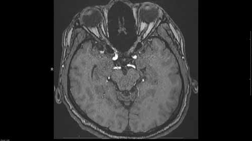 头部磁共振血管造影