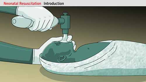 如何做新生儿复苏