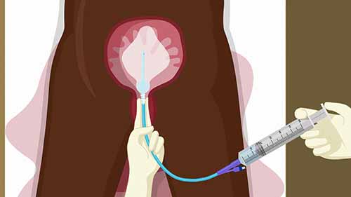 如何进行子宫气囊填塞