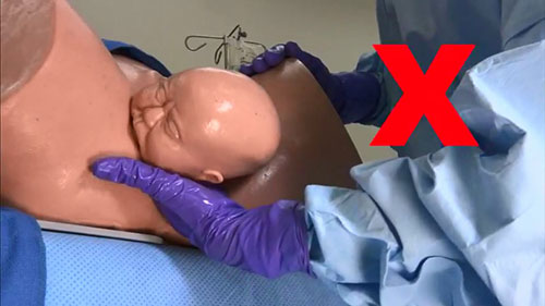 如何处理肩难产