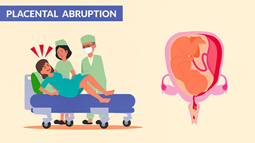 胎盘早剥基础知识