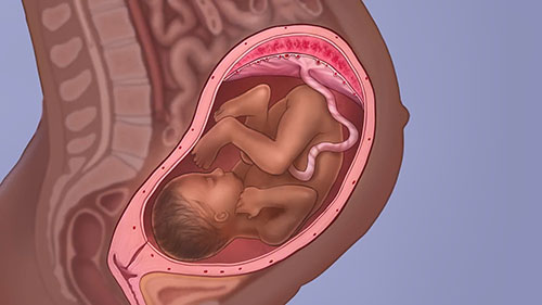 胎盘植入谱系疾病动画演示
