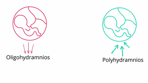 羊水过多与羊水过少