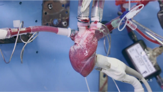 转基因猪心脏移植